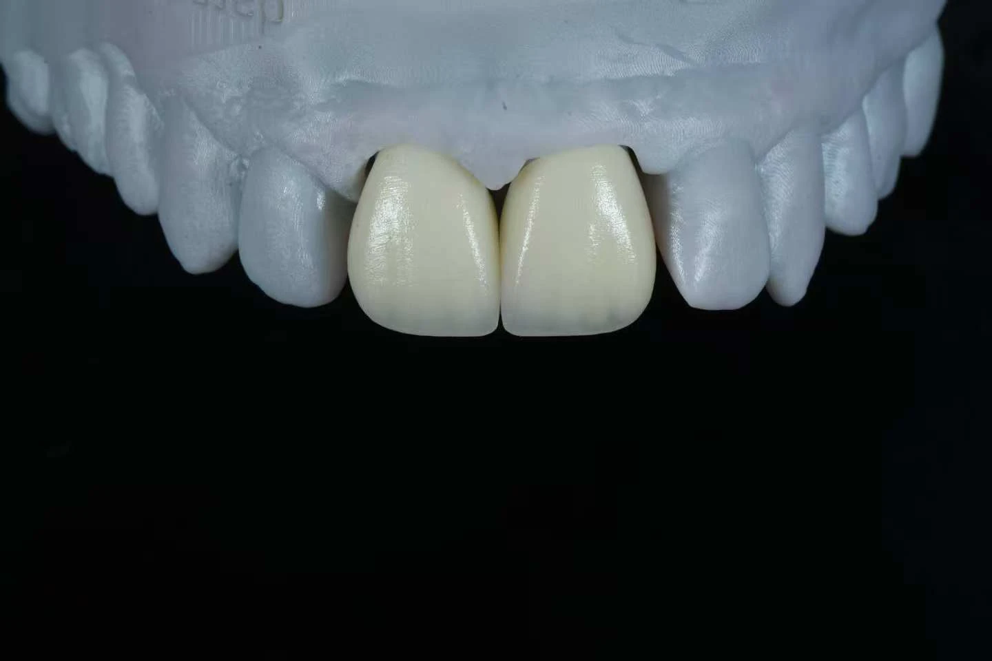 Feldspathic veneers for anterior teeth on upper dental model Feldspathic veneers for anterior teeth on upper dental model