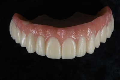 Korona tymczasowa z żywicy akrylowej