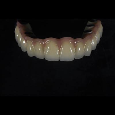 Most koronowy na implantach PFM